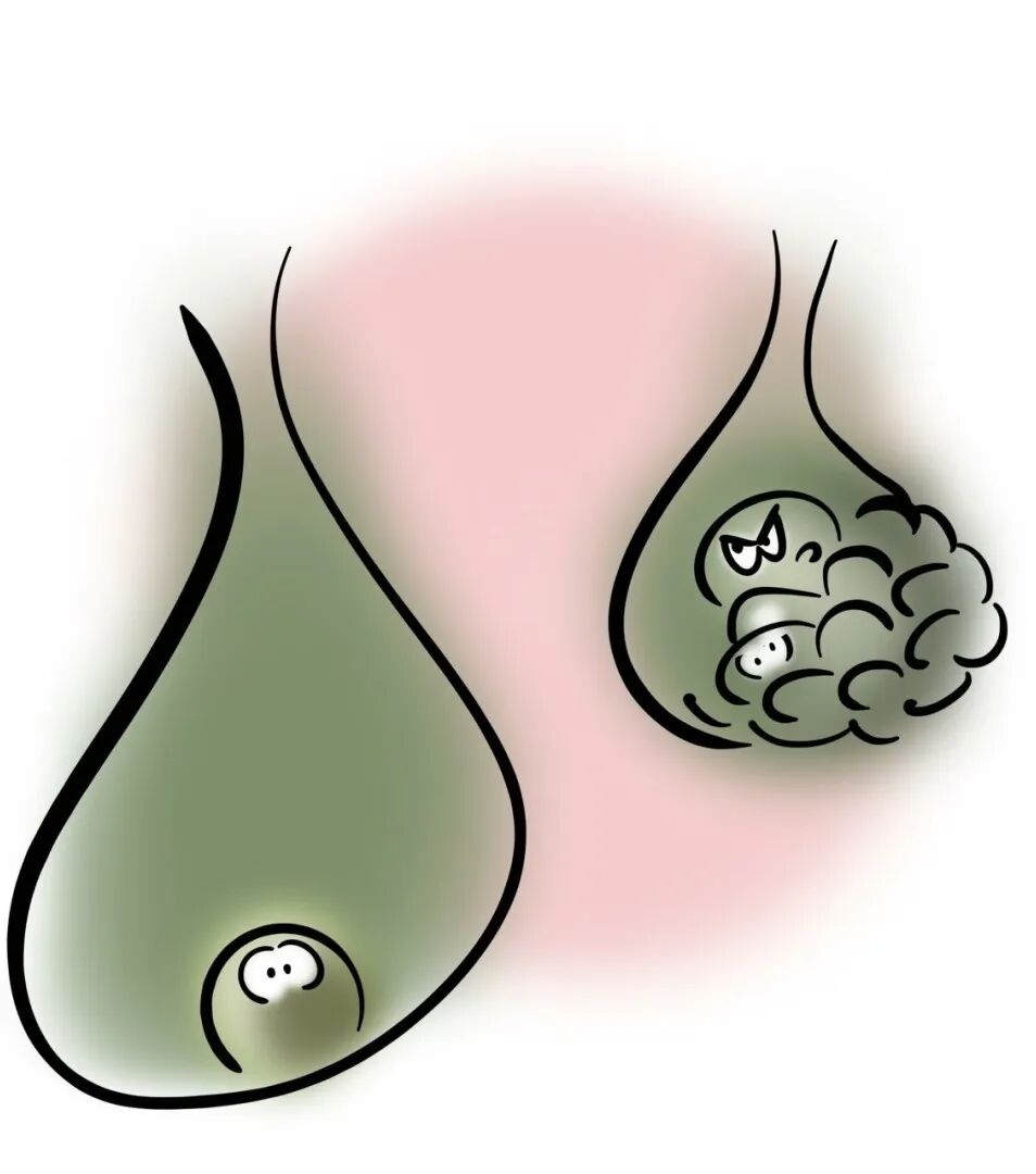 医生提醒：胆石症偏爱这六类人！做好这些事，远离胆石症→